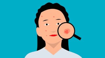 Entenda as diferenças entre cravo e espinhas